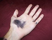 Take care of using Silver Nitrate